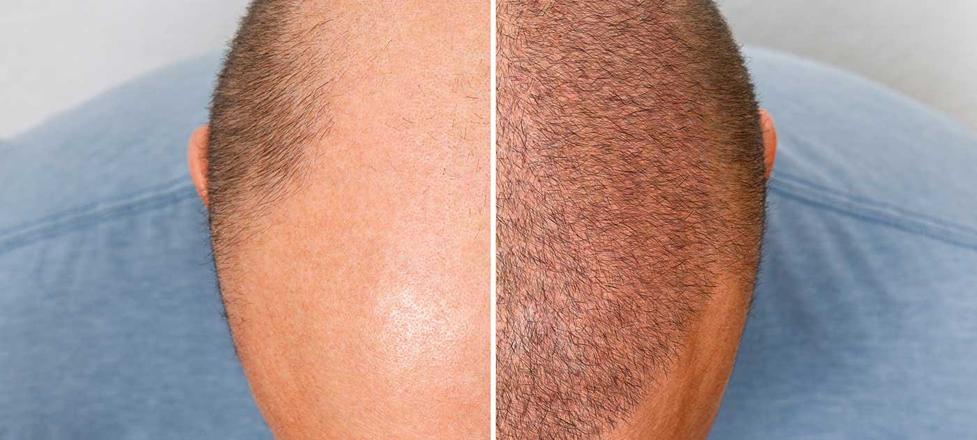 Greffe de cheveux à Montpellier par le dr Montaigne